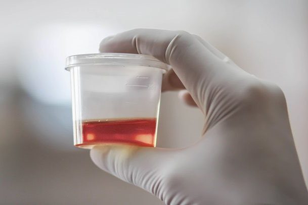 Hematuria. Urólogo Granada