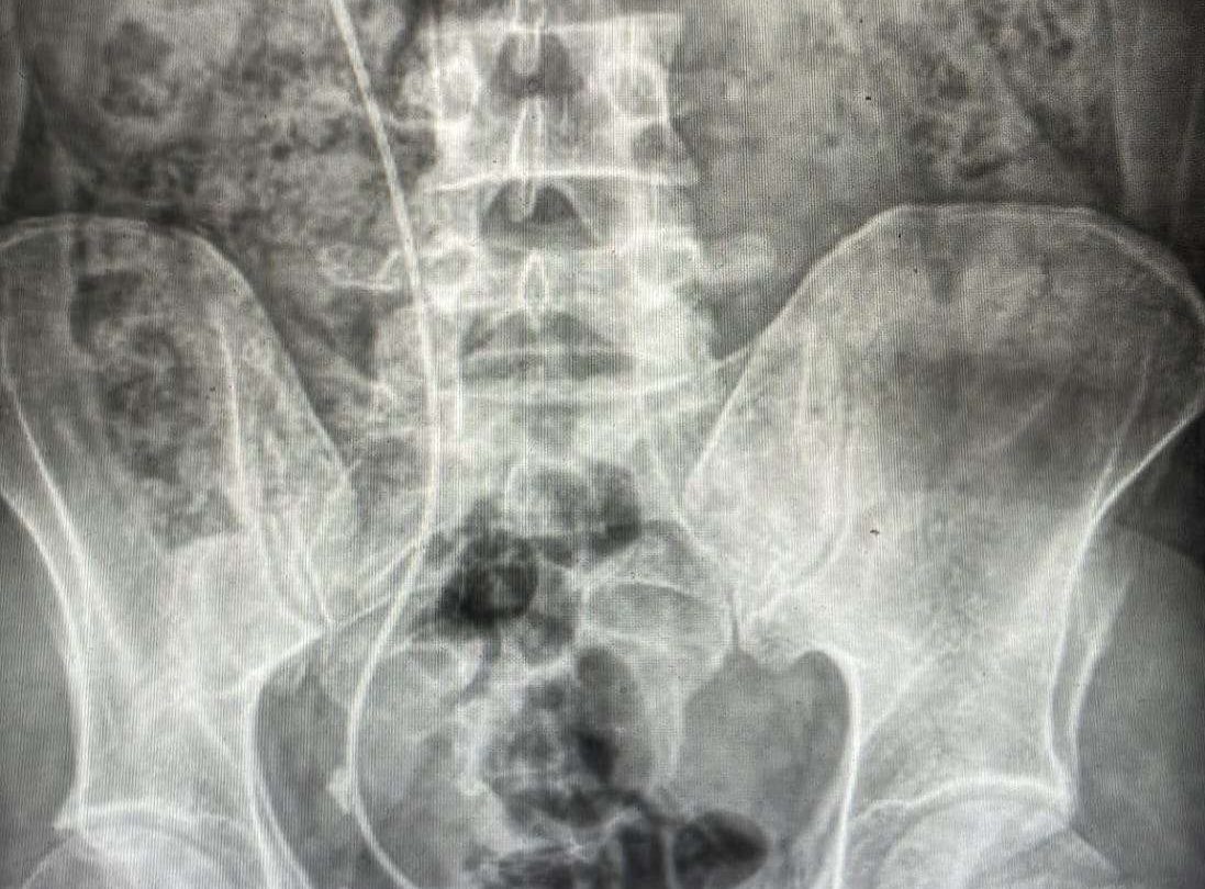 Imagen de litiasis ureteral derecha en paciente portadora de catéter doble J