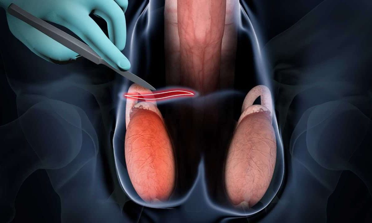 VASECTOMÍA 1