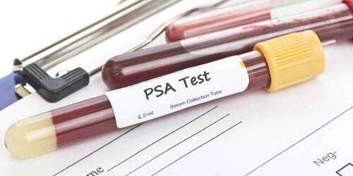 Análisis PSA próstata consulta urología Granada Análisis PSA próstata consulta urología Granada