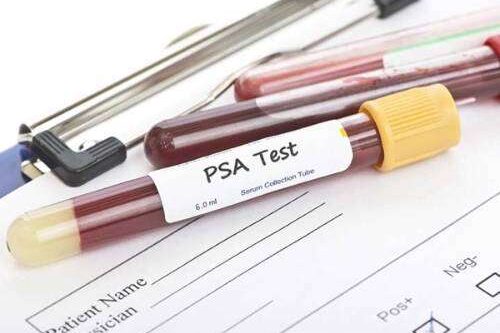 Análisis PSA próstata consulta urología Granada