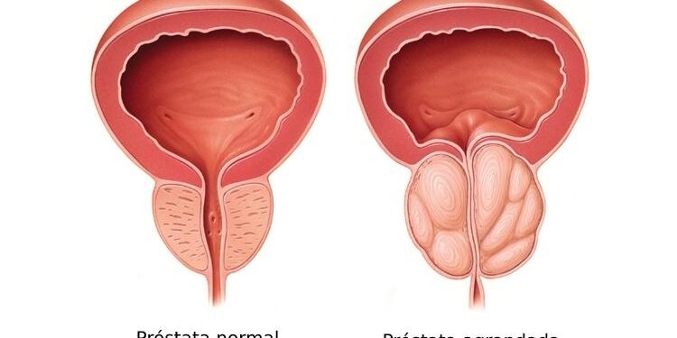 prostata-agrandada-granada